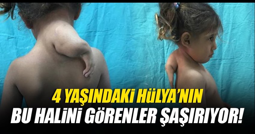 4 yaşındaki Hülya'nın 3'üncü kolu alındı