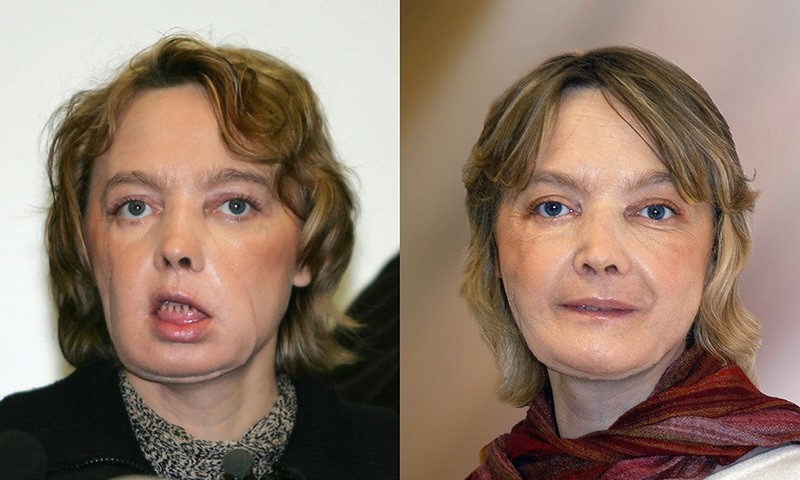 This combination of pictures (dated, (L) February 6, 2006 and (R)from November 2006) of French Isabelle Dinoire, 39, a few months after her surgery operation (AFP Photo)