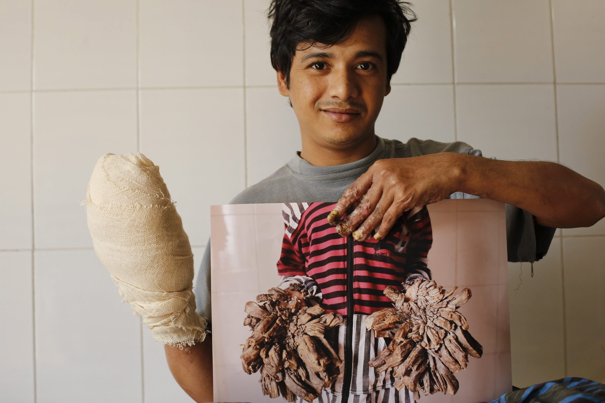 bul Bajandar, a patient diagnosed with epidermodysplasia verruciformis (EV), a rare skin disease, shows a photograph of his hands before operation. (EPA Photo)