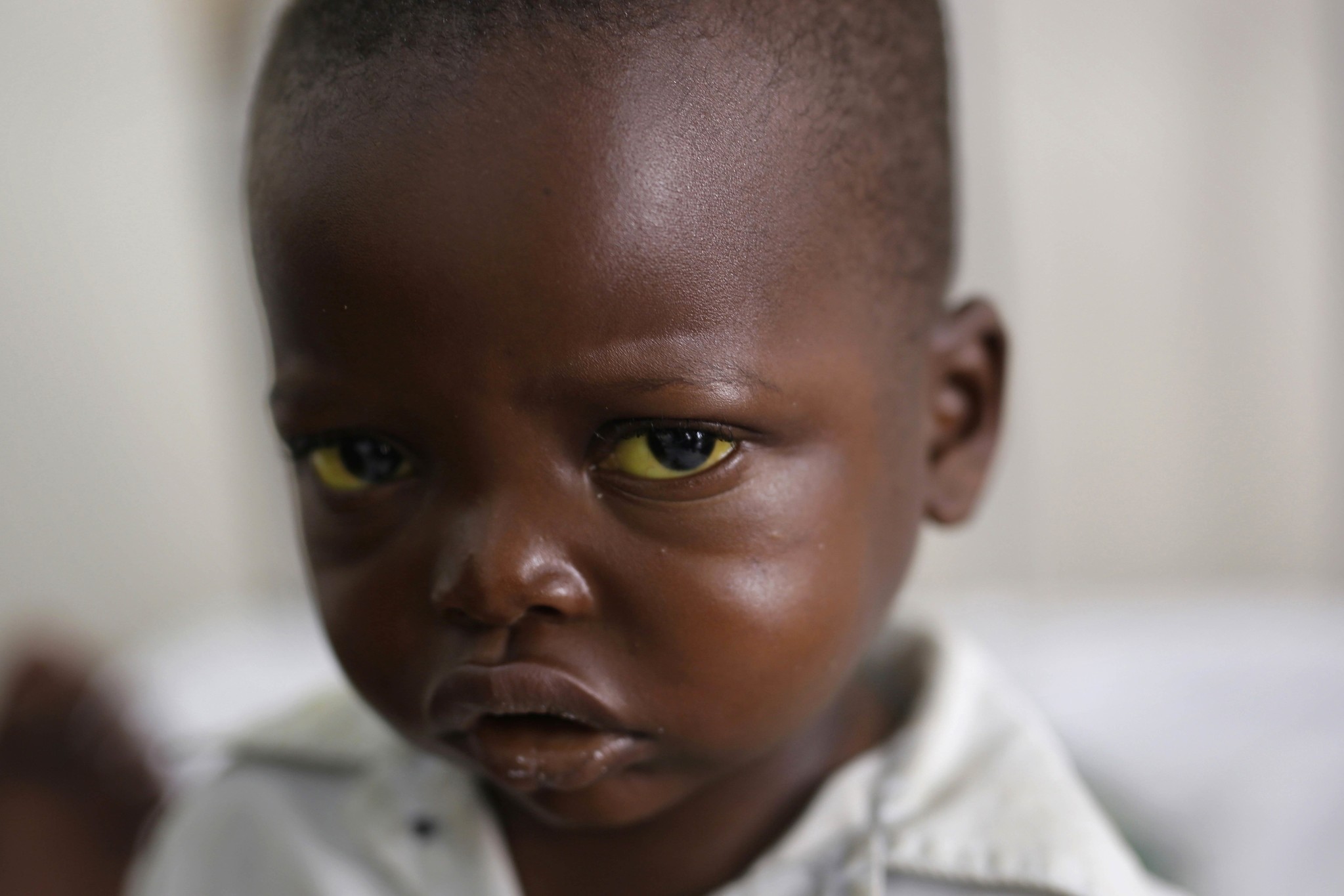 Three-year-old Jonathan Kangu sits on his hospital bed in Kinshasa, Congo, on Tuesday, July 19, 2016, suffering from symptoms of yellow fever, including yellowed eyes. (AP Photo)