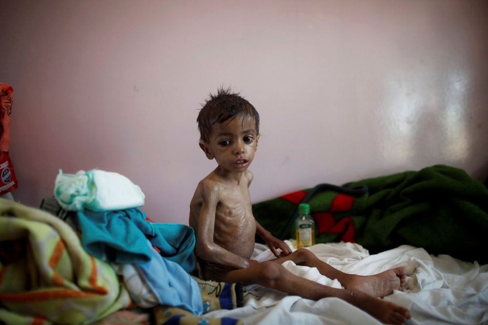A malnourished boy sits on a bed at a malnutrition treatment center in Sanaa, Yemen, Oct. 30.