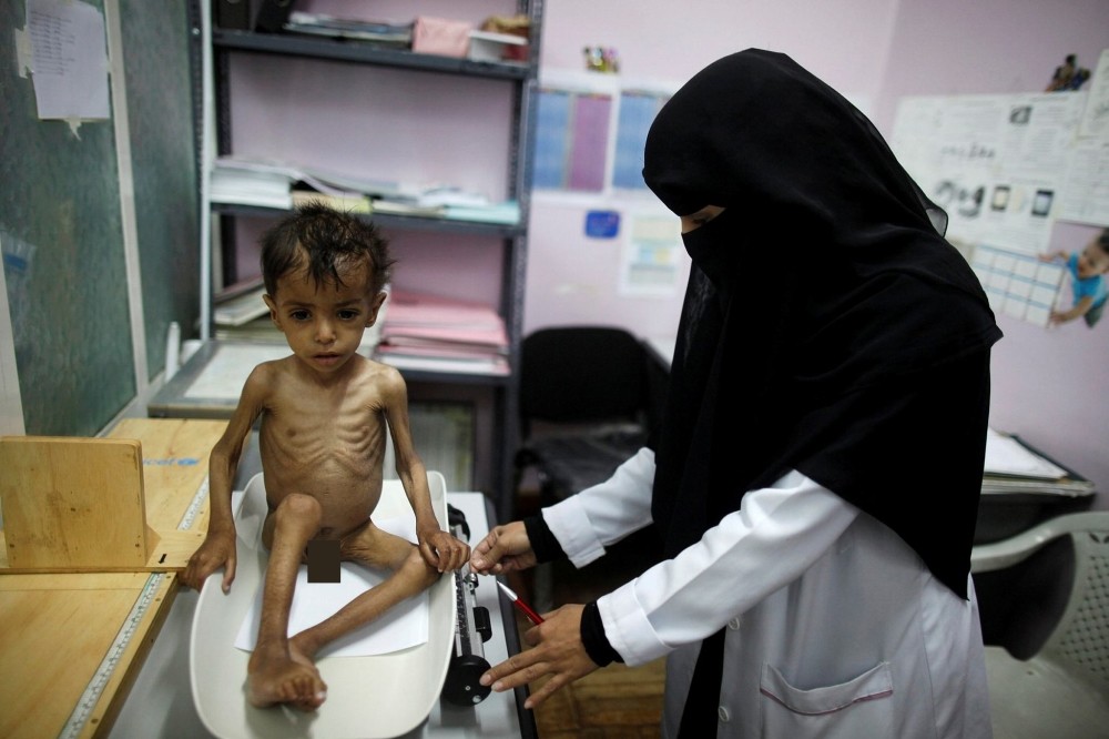 A nurse weighs a malnourished boy at a malnutrition treatment center in Sanaa, Yemen, Oct. 31.