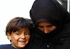 Suriyeli çocuk savaşın izlerini yüzünde taşıyor