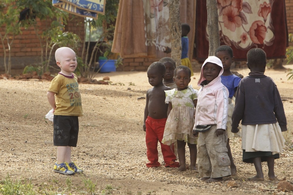 According to traditional belief, the bones of people with albinism contain gold. Their body parts are used as charms and magical potions in the belief that they bring wealth and good luck.