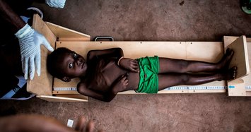 770,000 children suffer from acute malnutrition: UNICEF