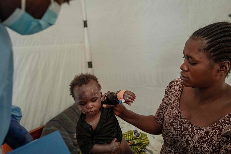 Photo Gallery | MPOX Guide: Here are transmission routes, symptoms, and ...