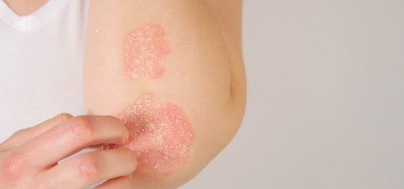 Understanding psoriasis: Causes, prevalence, and treatment