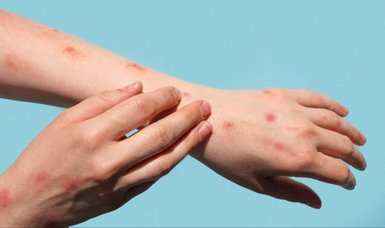 Chikungunya virus alarm in China