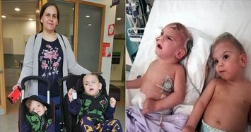 Turkish conjoined twins to return after successful op in UK