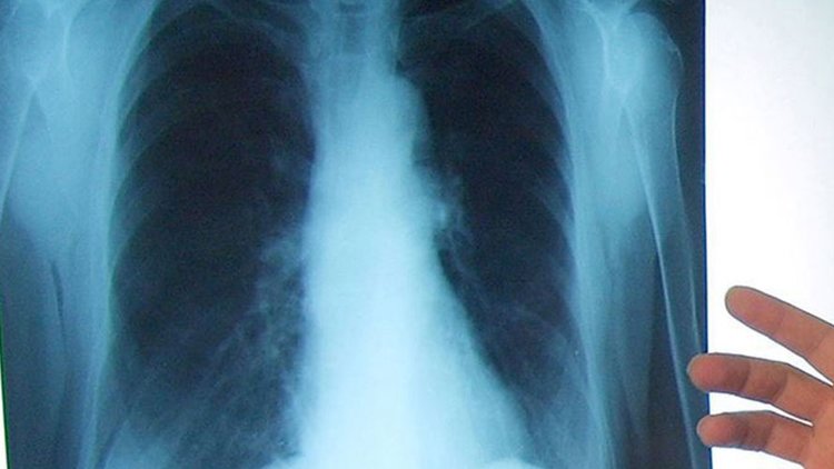Akciğer kanserinde yeni tedavi yöntemleri sağ kalım süresini artırıyor