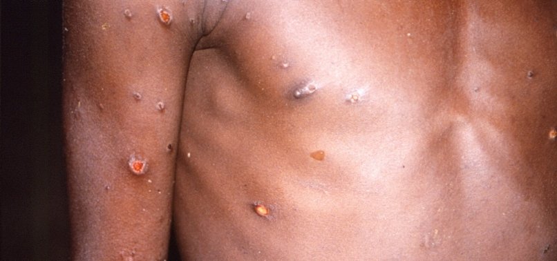 MONKEYPOX SPREADS TO ITALY AND SWEDEN AS WHO RAISES ALARM