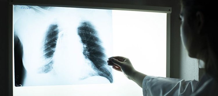 Aşırı kiloluların akciğerlerinde astıma yol açan yağ dokusu tespit edildi