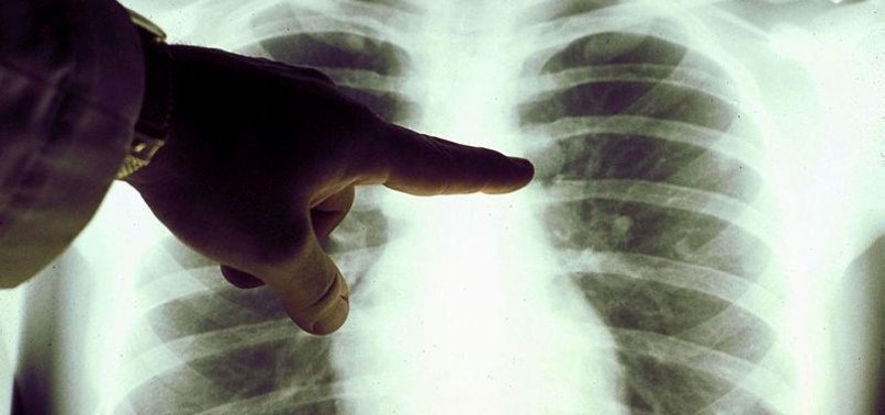 MORE THAN 27,000 TURKISH PATIENTS DIAGNOSED WITH LUNG CANCER EVERY YEAR