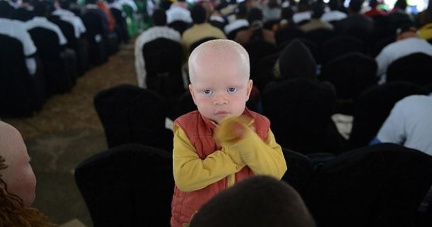 Kenya’daki albinolar büyücülerin kıskacında