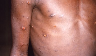 Monkeypox becoming 'cause for concern' in South Africa, says health minister