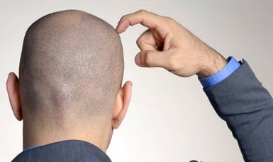 Sugary drinks, alcohol may cause hair loss, study says