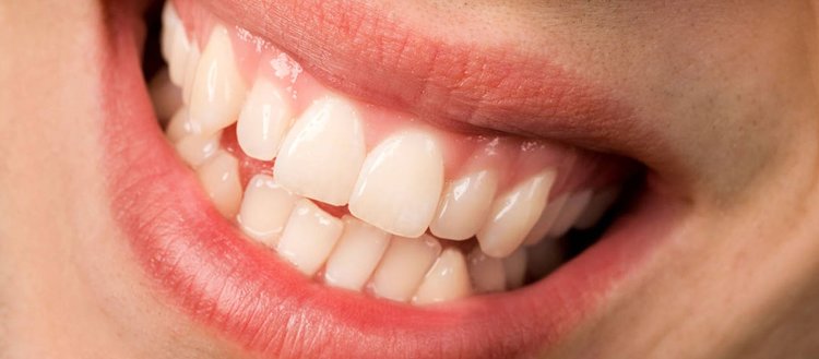 ’Çapraşık dişler için tek tedavi yöntemi diş teli değil’