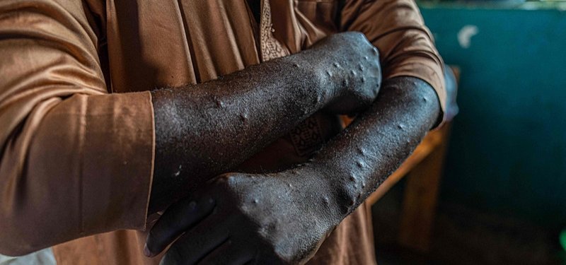 African countries, partners pledge $800M for Africa’s mpox response