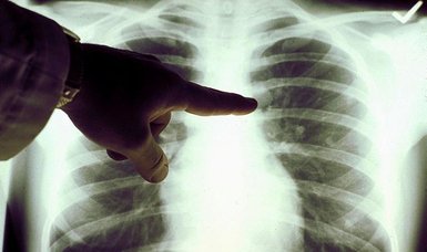 More than 27,000 Turkish patients diagnosed with lung cancer every year