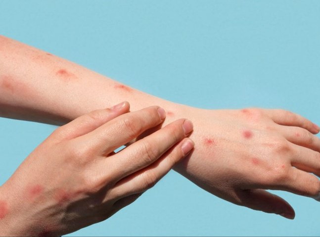 Chikungunya virus alarm in China