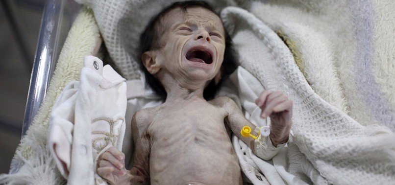 CHILD MALNUTRITION IN SYRIAS OPPOSITION-HELD GHOUTA WORST IN THE WAR, UN SAYS