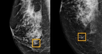 AI can detect breast cancer missed by doctors, study shows