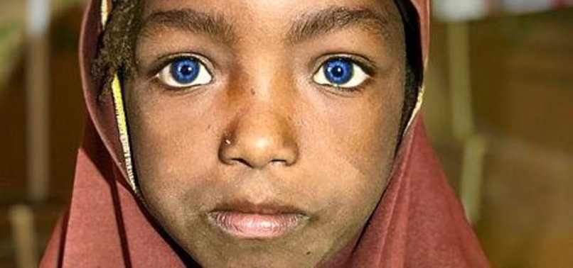 TURKISH AID GROUP IHH HELPS NIGERIEN GIRL AT RISK OF LOSING EYESIGHT