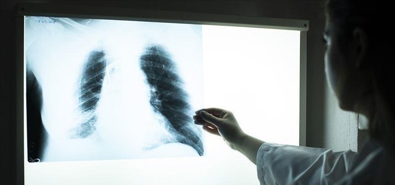 ENGLAND SEES 7% RISE IN TUBERCULOSIS CASES IN 1ST HALF OF 2023