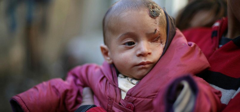 BLINDED IN ONE EYE, SYRIAN BABY BECOMES SYMBOL OF SIEGE