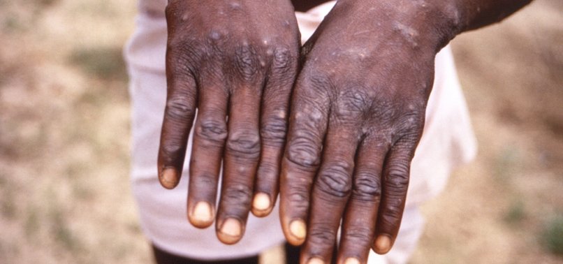WHO: MORE THAN 6,000 MONKEYPOX CASES REPORTED, EMERGENCY MEETING SET