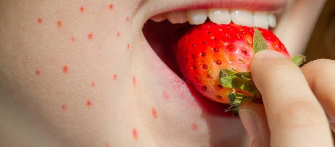 Hangi besinler alerjiye neden olur?