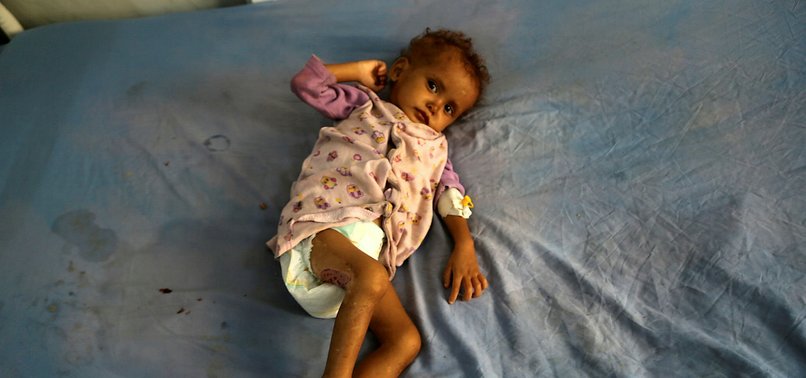 85,000 CHILDREN MAY HAVE DIED FROM FAMINE IN YEMEN