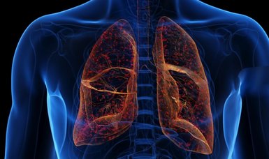 Early diagnosis key to managing bronchiectasis