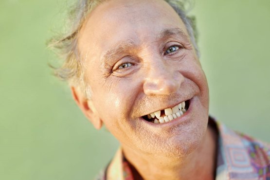 Eksik dişler yüzde kırışıklığa neden oluyor