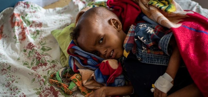 UN WARNS SEVERE CHILD MALNUTRITION HAS BEEN INCREASING IN TIGRAY REGION