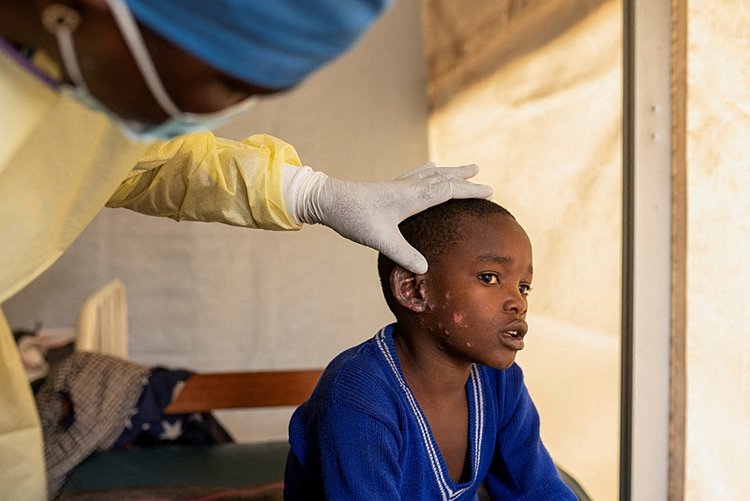 Photo Gallery | MPOX Guide: Here are transmission routes, symptoms, and ...