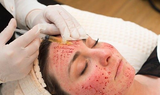 Women diagnosed with HIV after getting “vampire facial” procedures