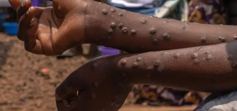34 MPOX CASES DETECTED IN GHANA