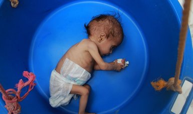 3-year-old Randa starves as Yemen aid dries up