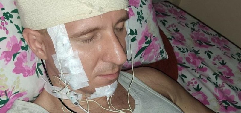RUSSIAN MAN, MICHAEL RADUGA, PIERCES HEAD WITH DRILL TO IMPLANT A CHIP IN BID TO CONTROL DREAMS