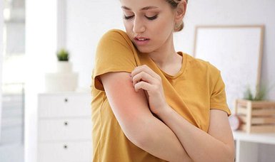Scabies on the Rise: How to Protect Yourself | Scabies Prevention: What You Need to Know
