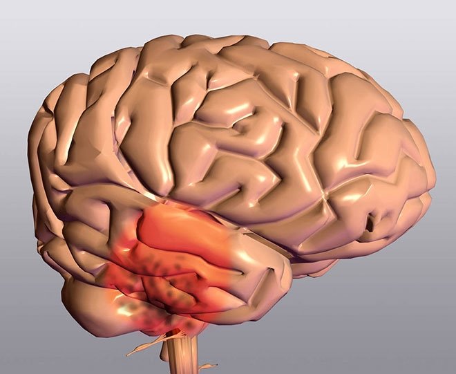 parkinson hastaligi belirtileri ve