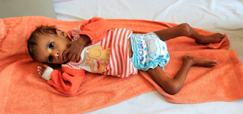 CONFLICT-RAVAGED YEMENS INFANTS FACE STARVATION AS WAR RAGES ON