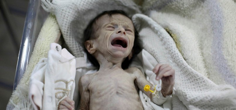 UN WARNS ON STARVING OF CHILDREN IN SYRIAS DAMASCUS SUBURB