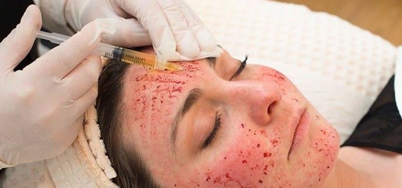 Three women diagnosed with HIV after getting “vampire facial” procedures