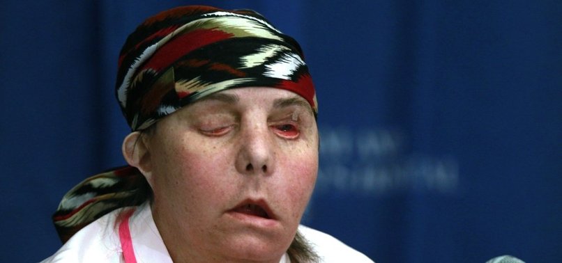 A US FIRST, NEW HAMPSHIRE WOMAN GETS SECOND FACE TRANSPLANT