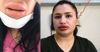 Dudak silikonu faciasında yeni mağdur çıktı