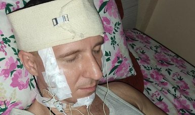 Russian man, Michael Raduga, pierces head with drill to implant a chip in bid to control dreams