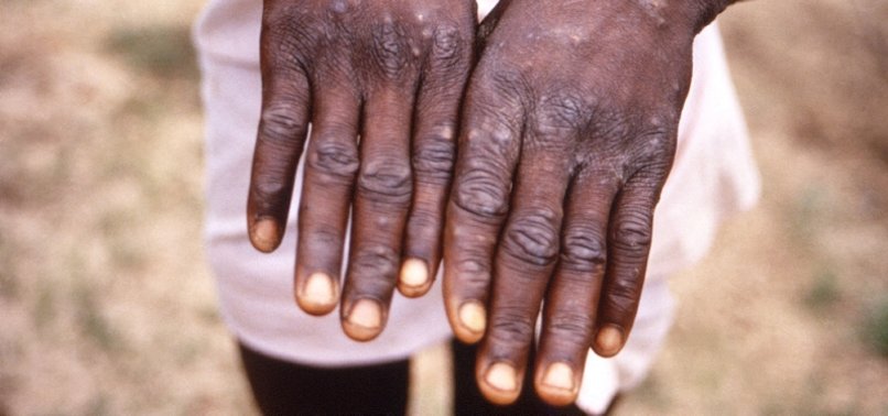ISRAEL CONFIRMS 1ST CASE OF MONKEYPOX