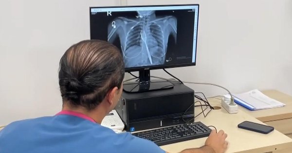 The 18-centimeter fork she swallowed was removed by surgery